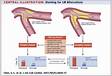 Managing Bifurcation Lesions in Coronary Ostial Stenosi